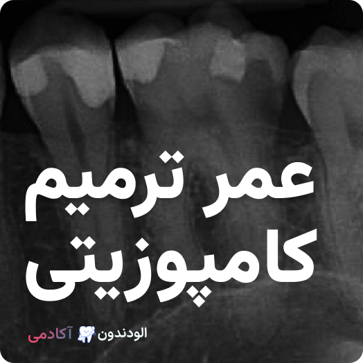 عمر ترمیم کامپوزیت
